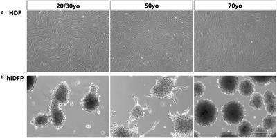 Reprogramming of adult human dermal fibroblasts to induced dorsal forebrain precursor cells maintains aging signatures